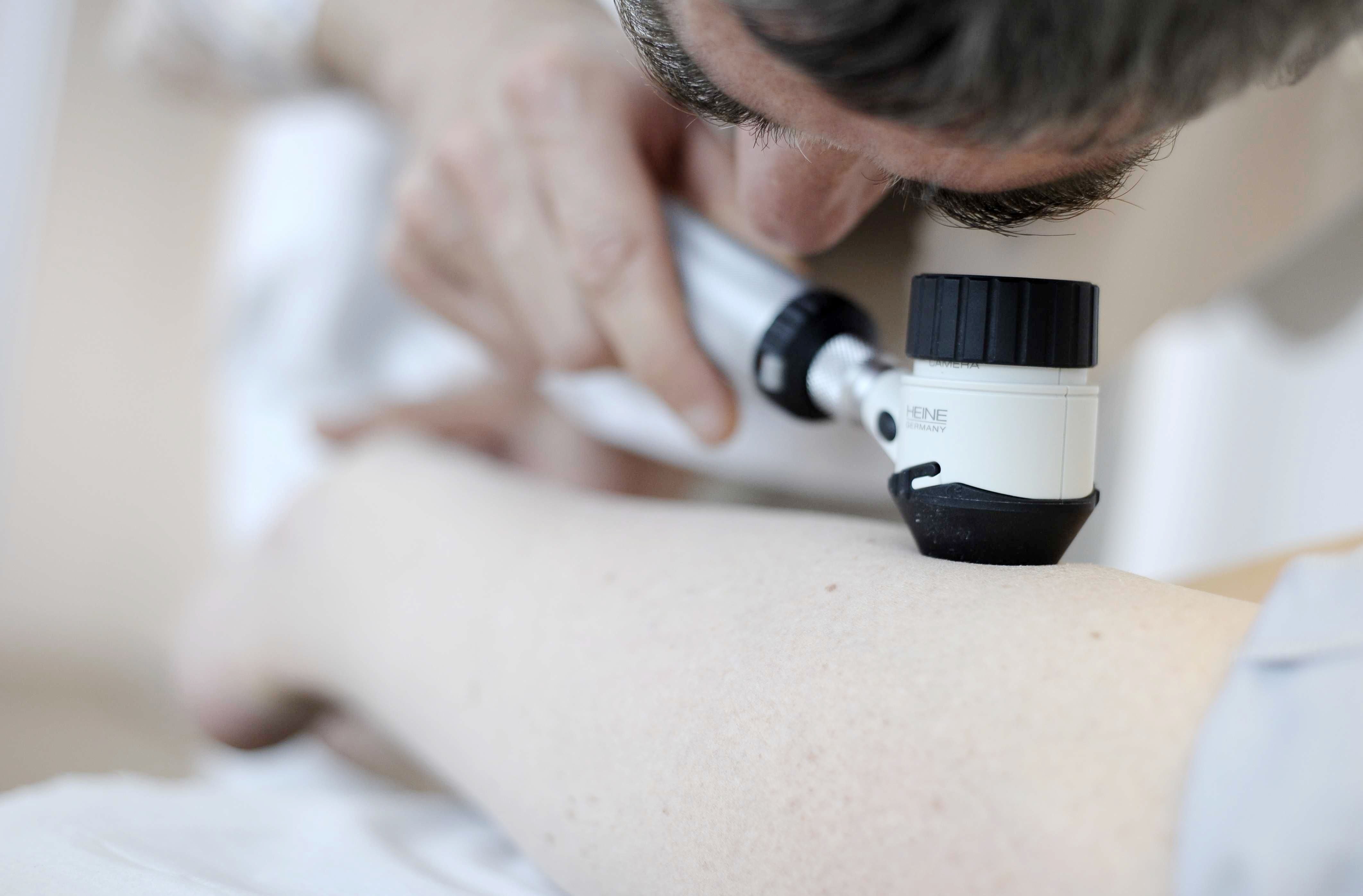 Researchers warn eleven moles on your arm could indicate skin cancer