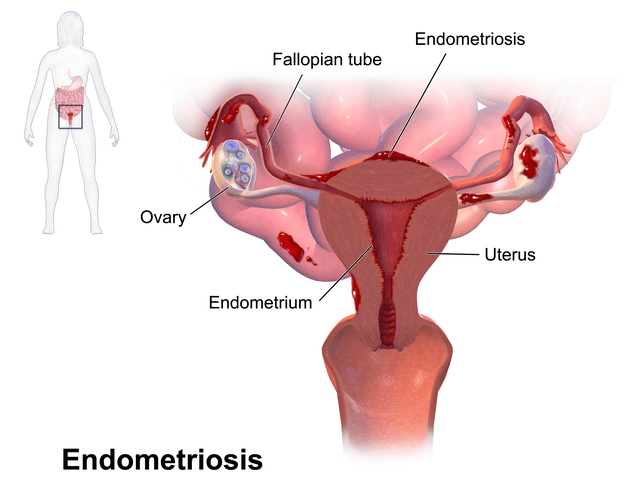 The ‘mysterious’ condition: Why Endometriosis takes years to diagnose