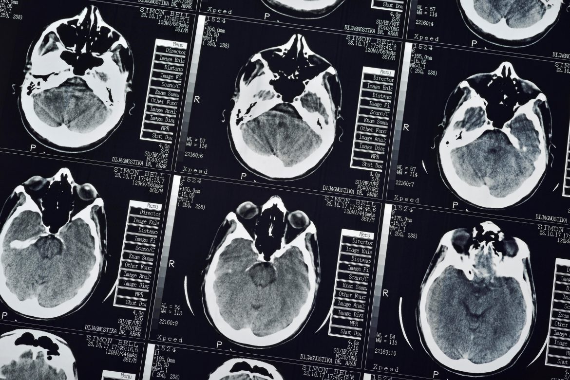 Explainer: What are brain tumours, and what symptoms should you look out for?
